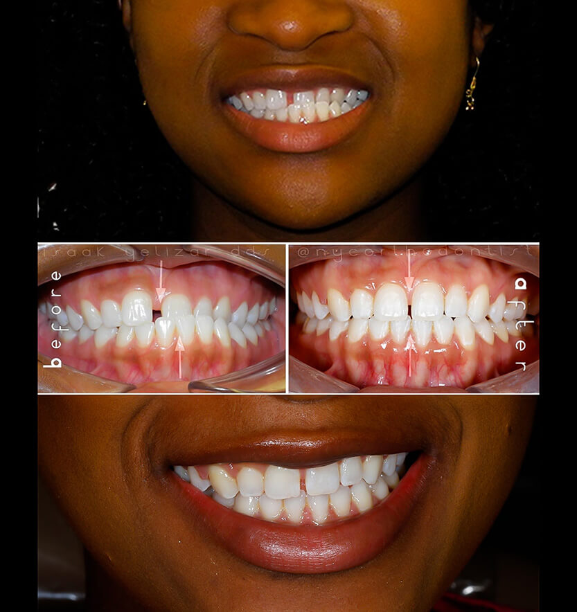 anterior-crossbite-1-min1