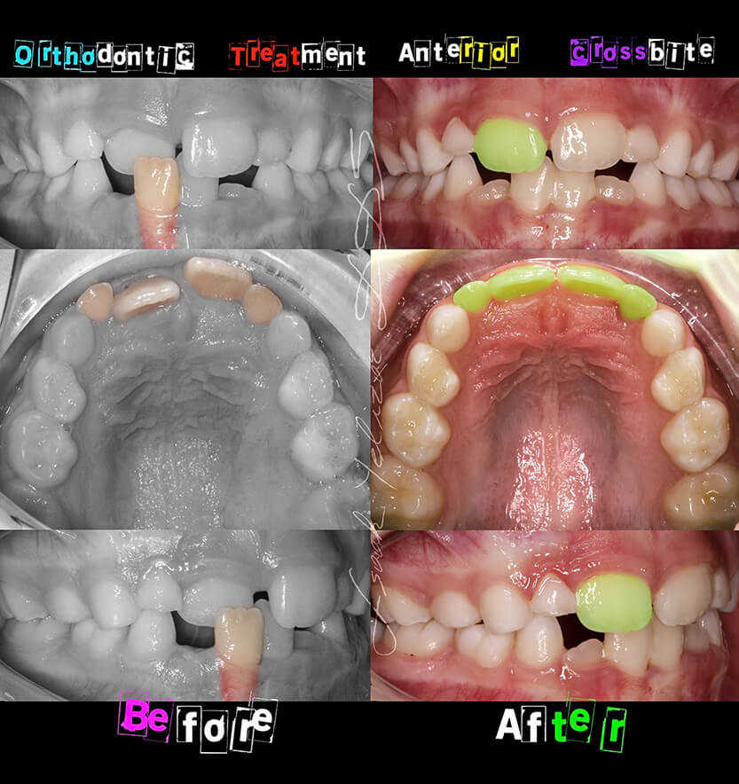anterior-crossbite-2-min2