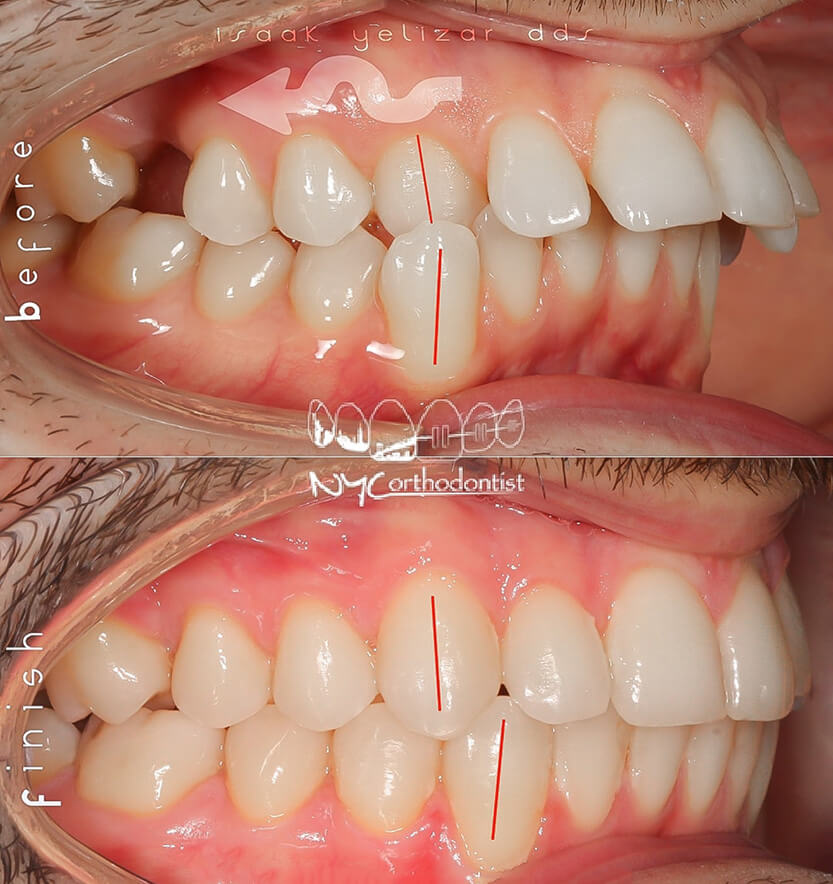 anterior-crossbite-3-min3