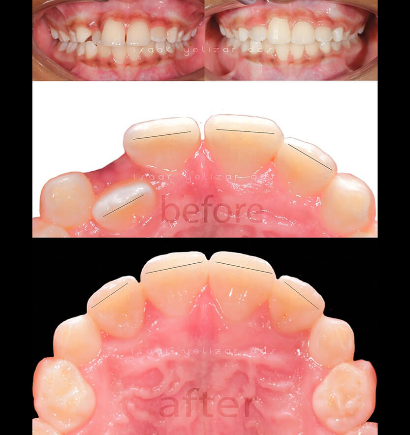 anterior-crossbite-5-min5