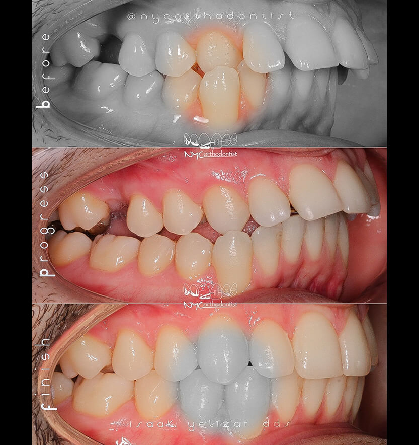 anterior-crossbite-6-min6