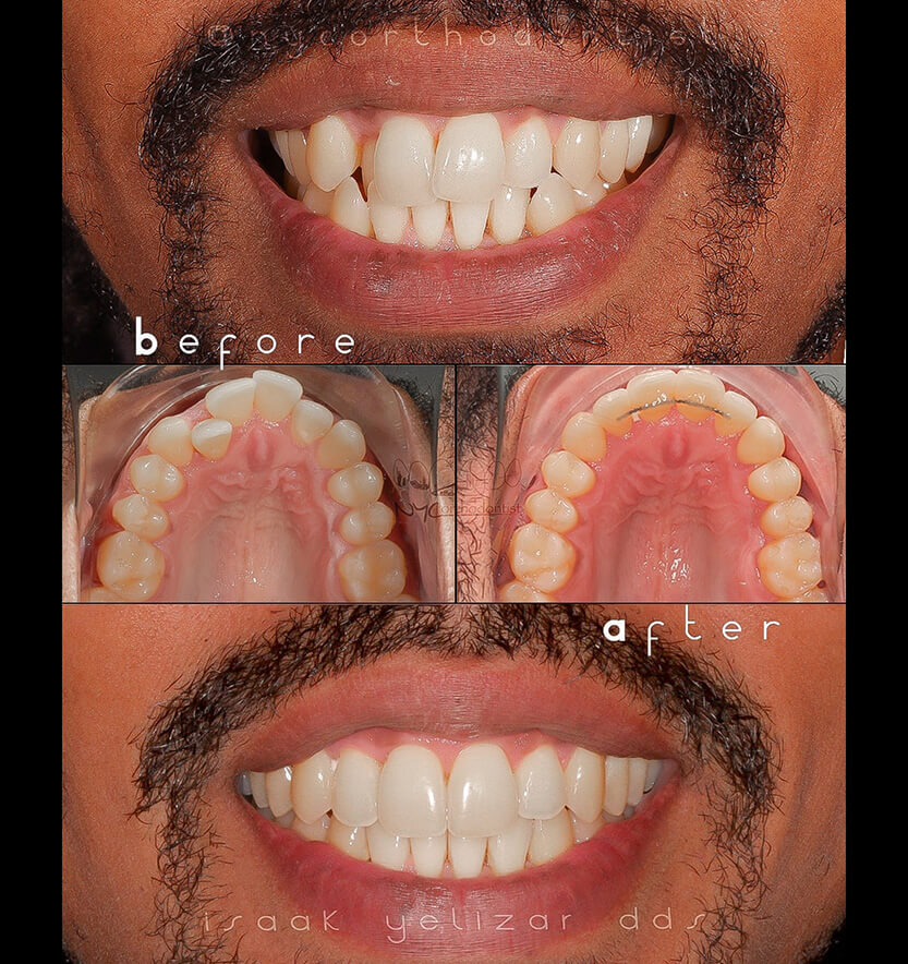 anterior-crossbite-7-min7