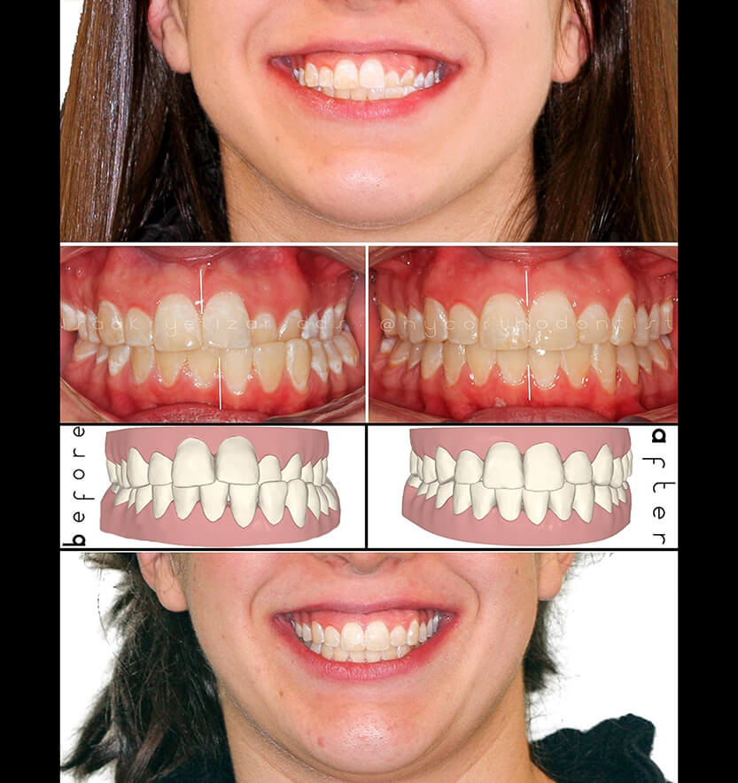 anterior-crossbite-8-min8
