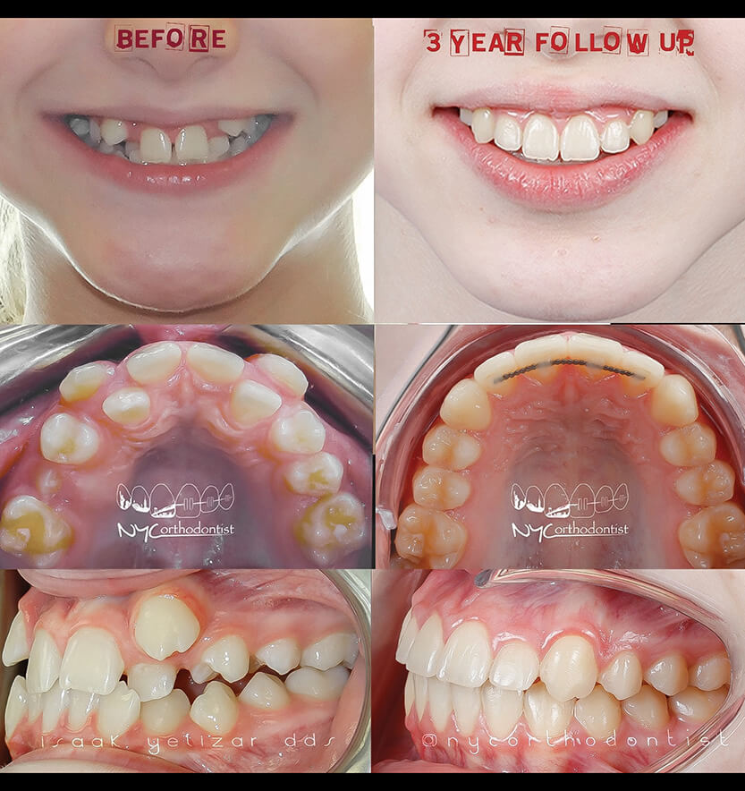 anterior-crossbite-9-min9