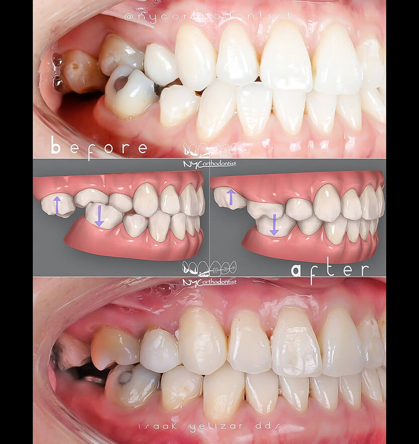 crossbite-1-min1