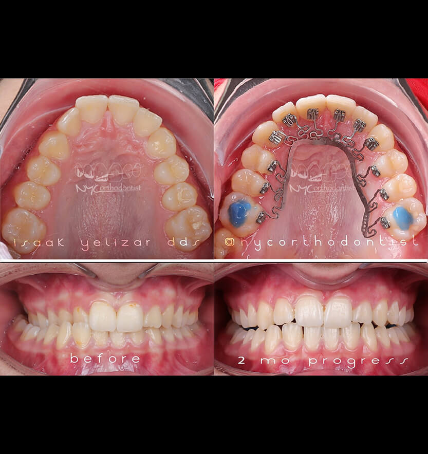 crossbite-2-min2