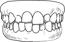 Crossbite