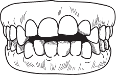 Open Bite
