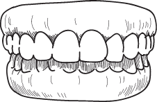 Overbite