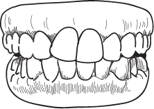 Crooked Teeth