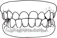 Underbite