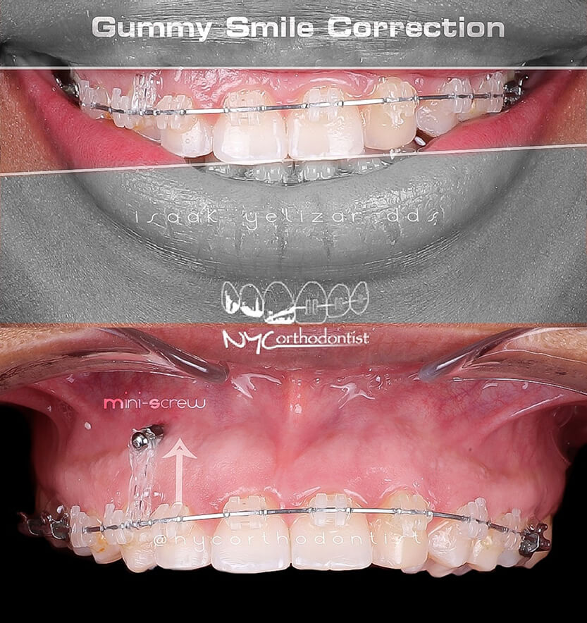 gummy-1-min1