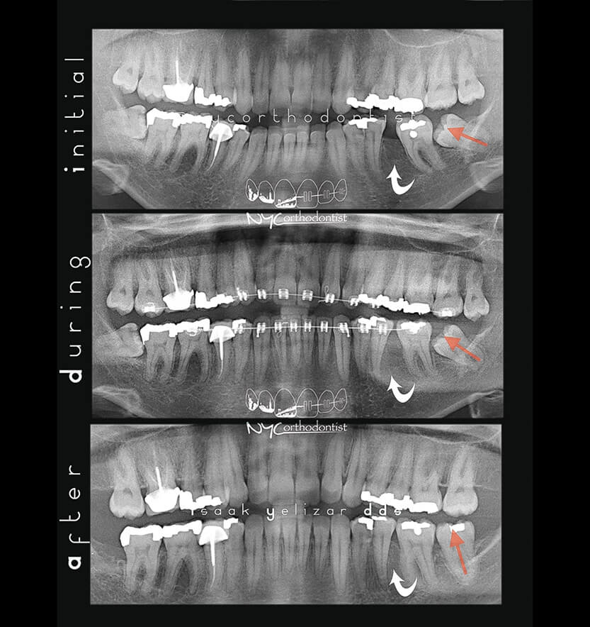 impacted-14-min14