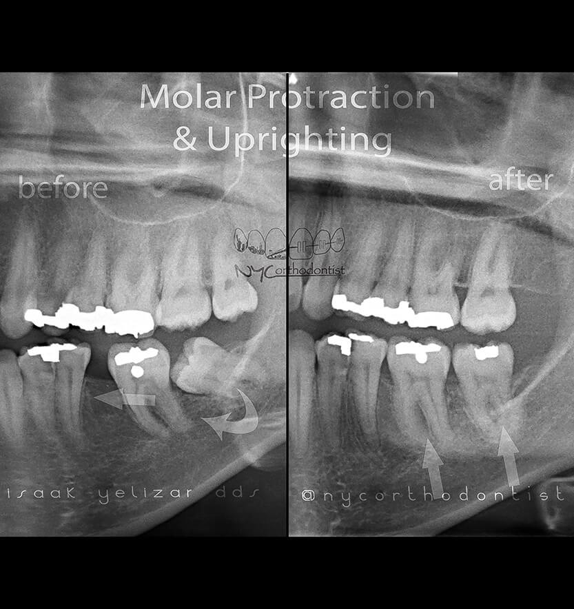 impacted-9-min9