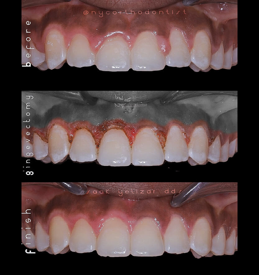 laser-reshaping-1-min1