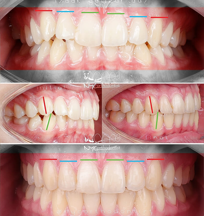 laser-reshaping-2-min2