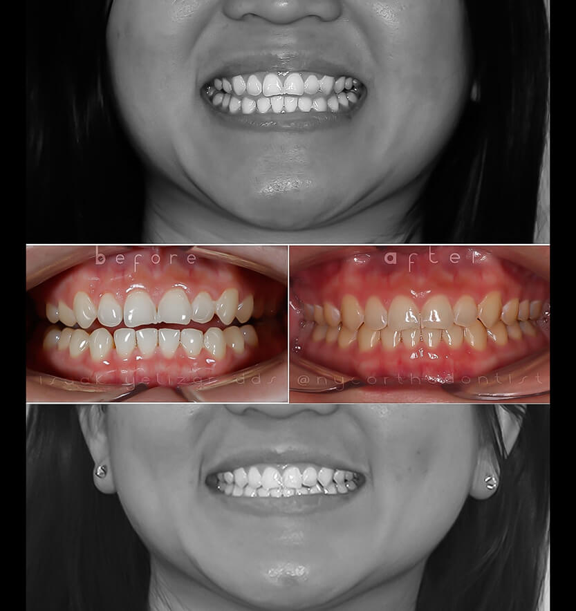 open-bite-1-min1