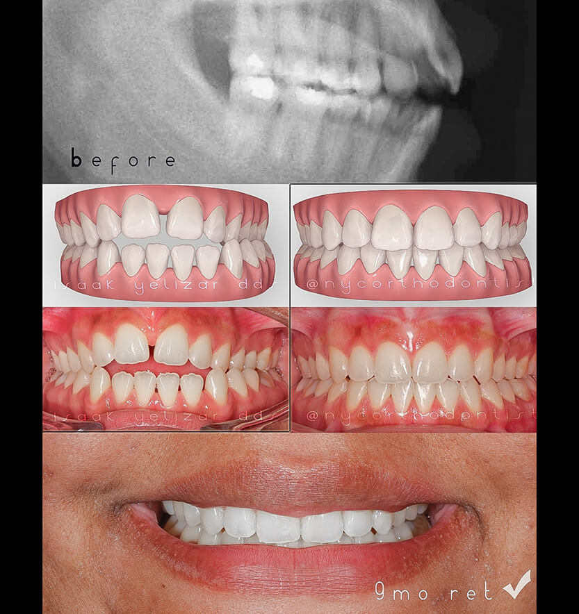 open-bite-2-min2