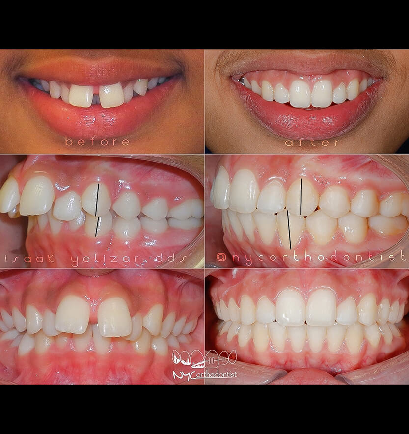overbite-1-min1