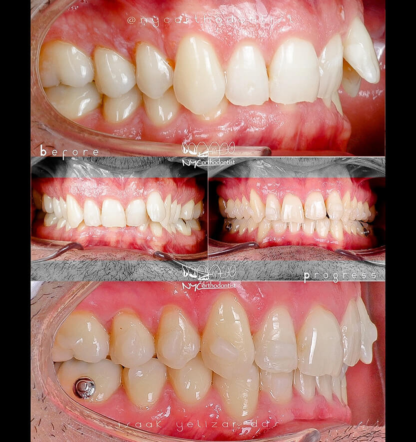 overbite-10-min10