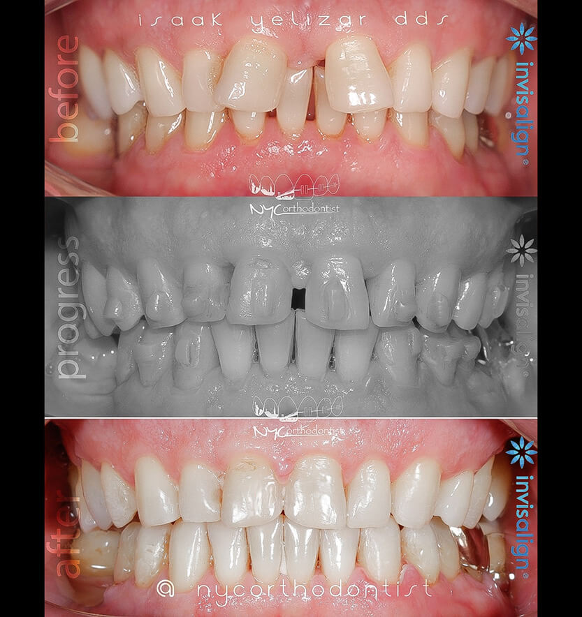 overbite-11-min11