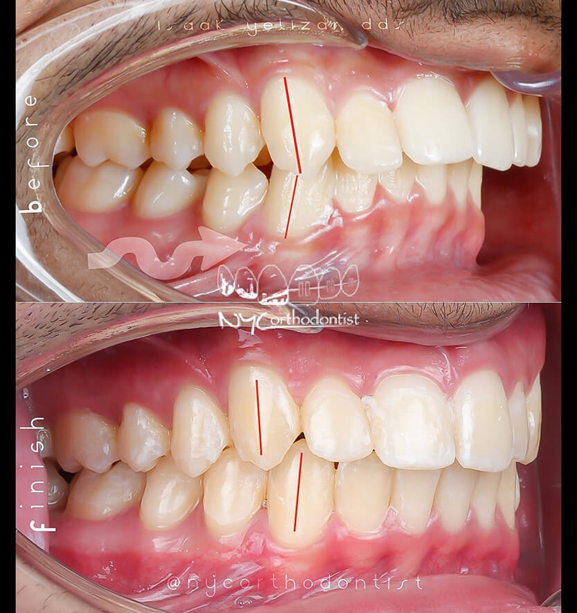 overbite-2-min2