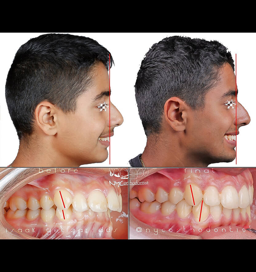 overbite-3-min3