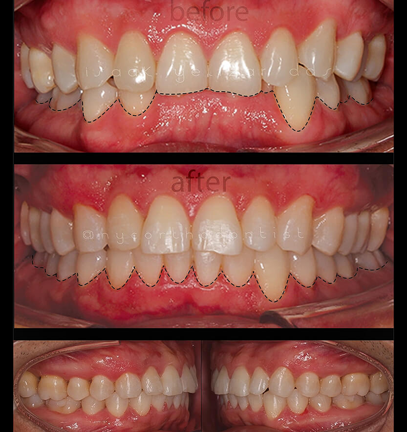 overbite-4-min4