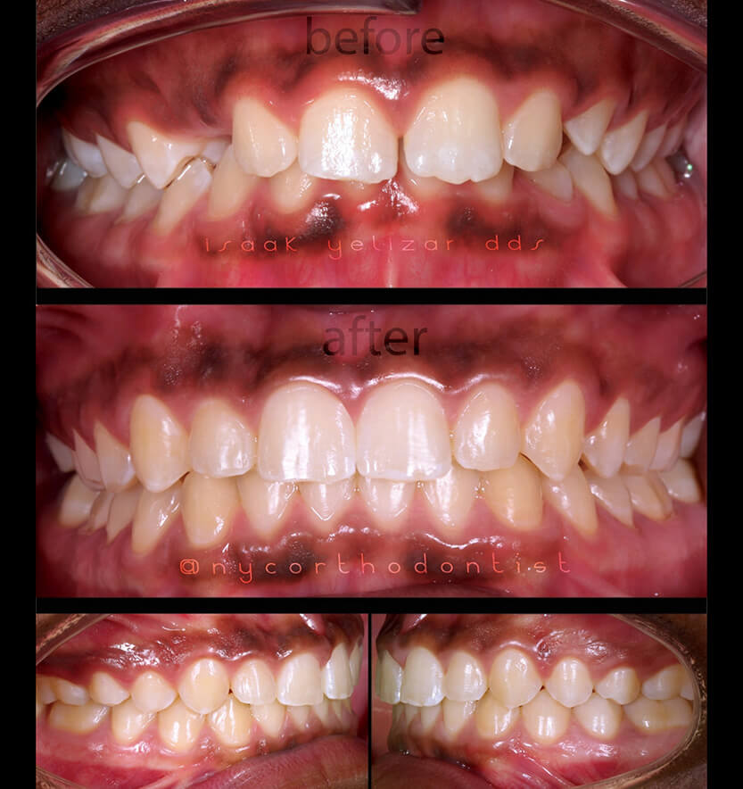 overbite-5-min5