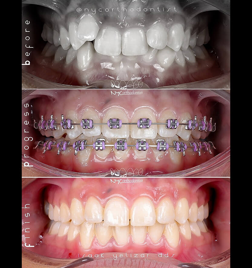 overbite-6-min6