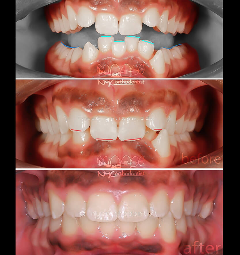 overbite-7-min7