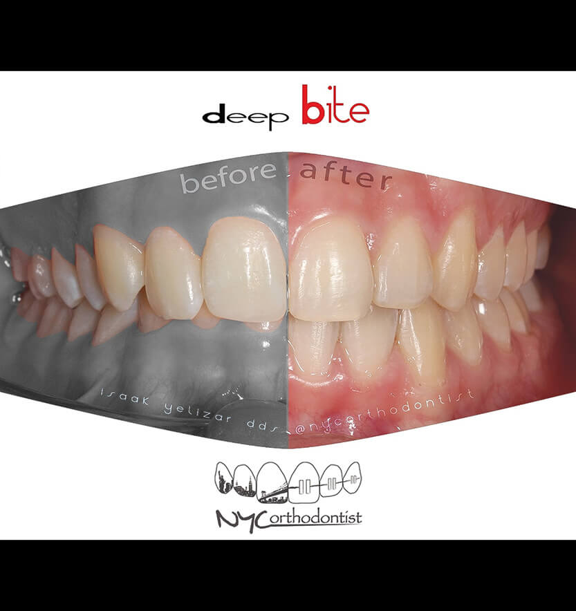 overbite-8-min8