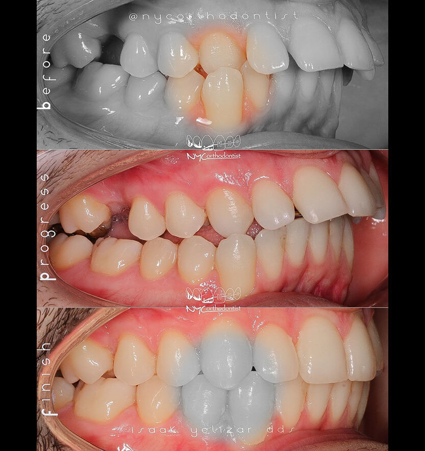 overbite-9-min9