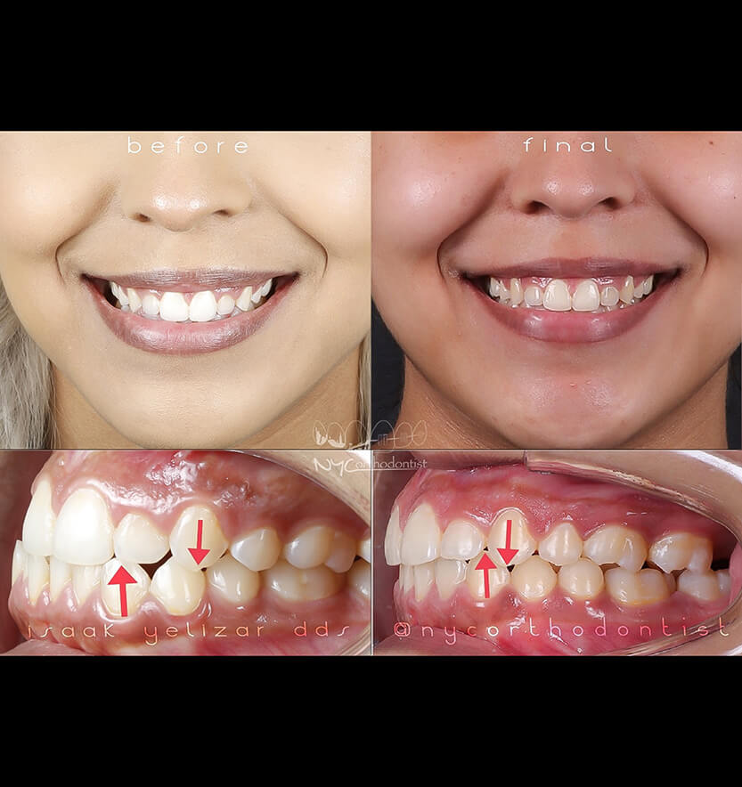 underbite-1-min1