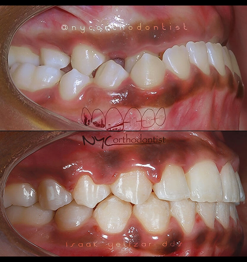 underbite-10-min10