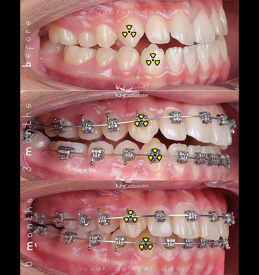 underbite-2-min2