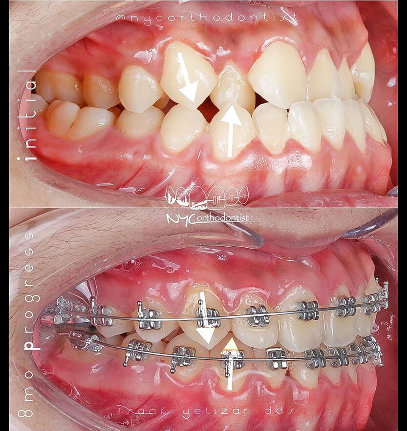 underbite-3-min3