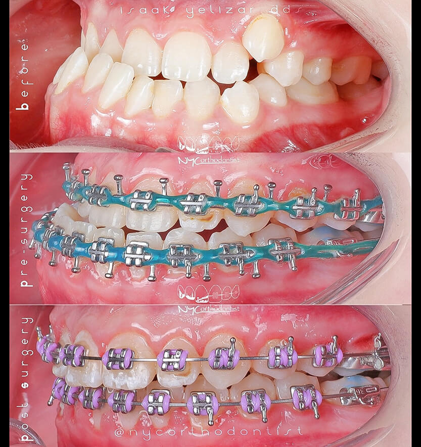 underbite-4-min4