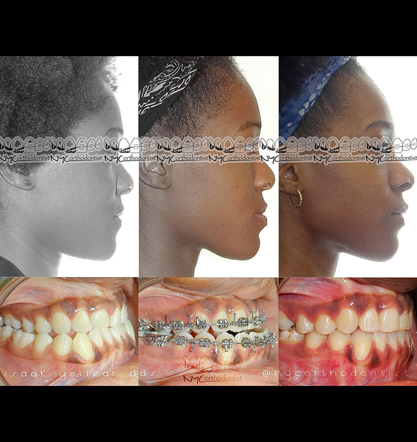 underbite-5-min5