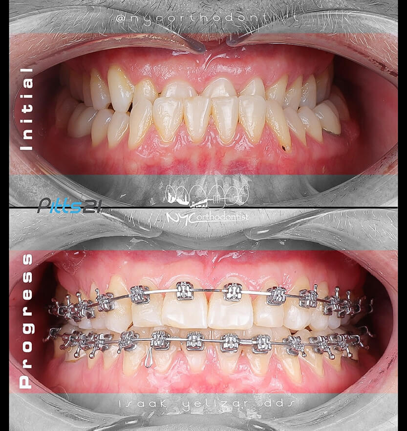 underbite-6-min6