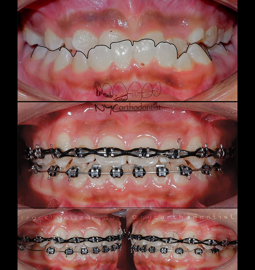underbite-7-min7