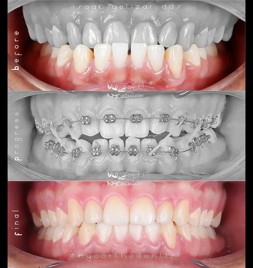 underbite-8-min8