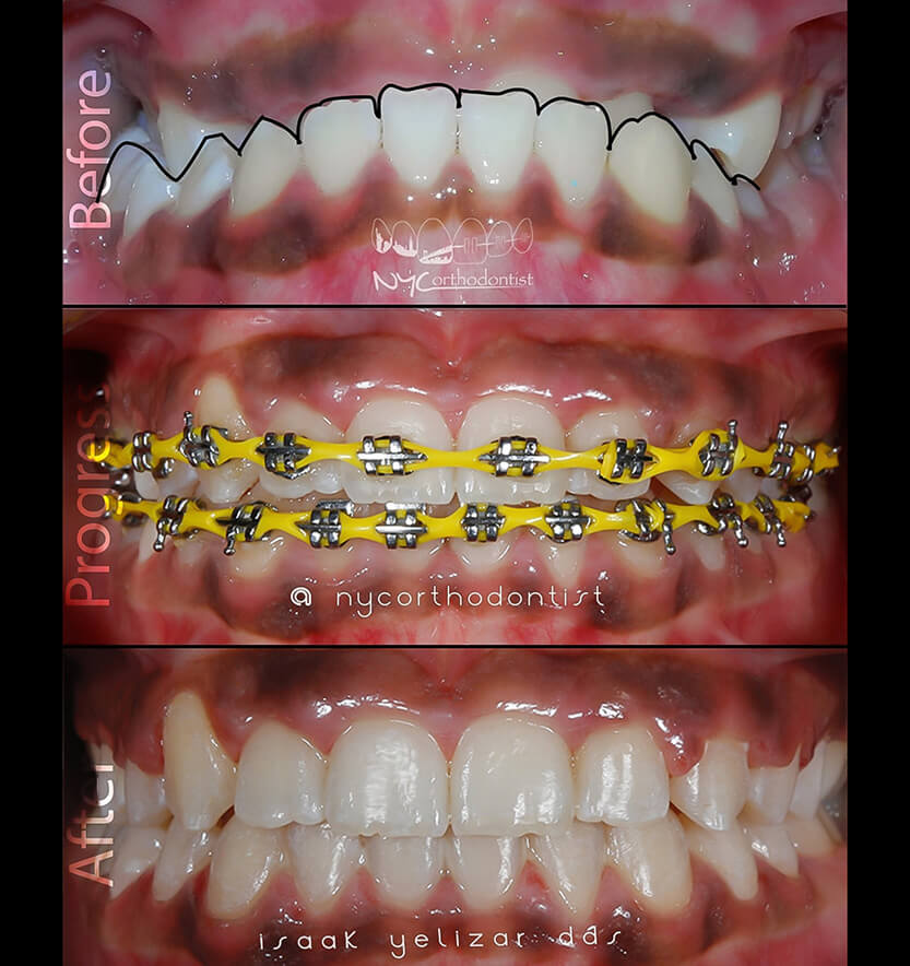 underbite-9-min9