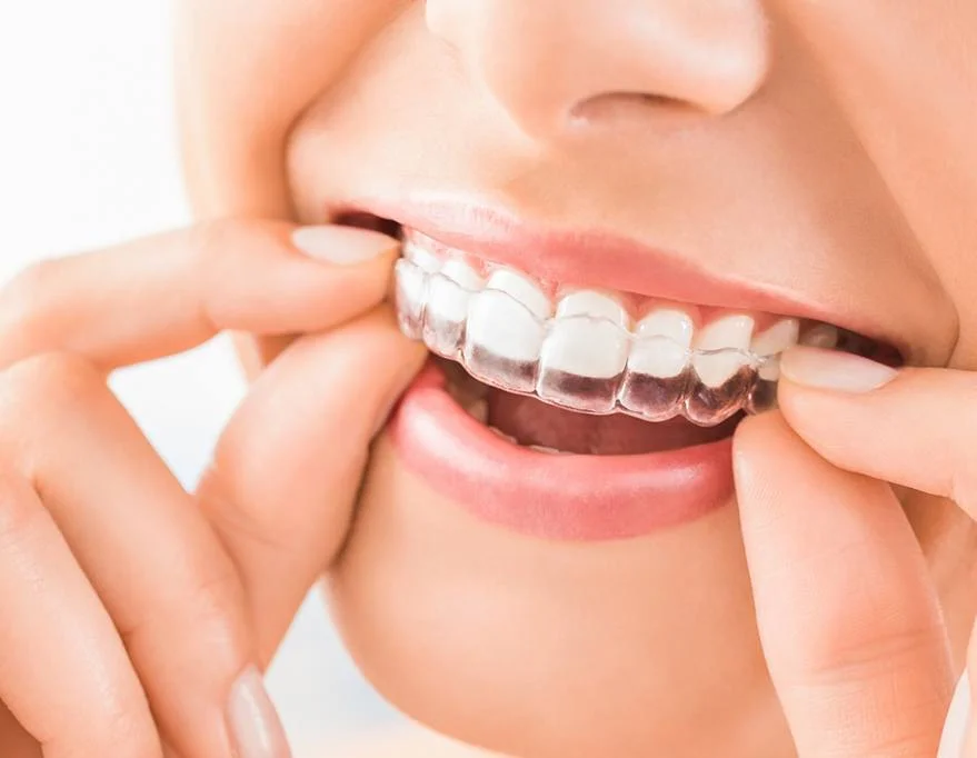 Clear aligner orthodontic treatment